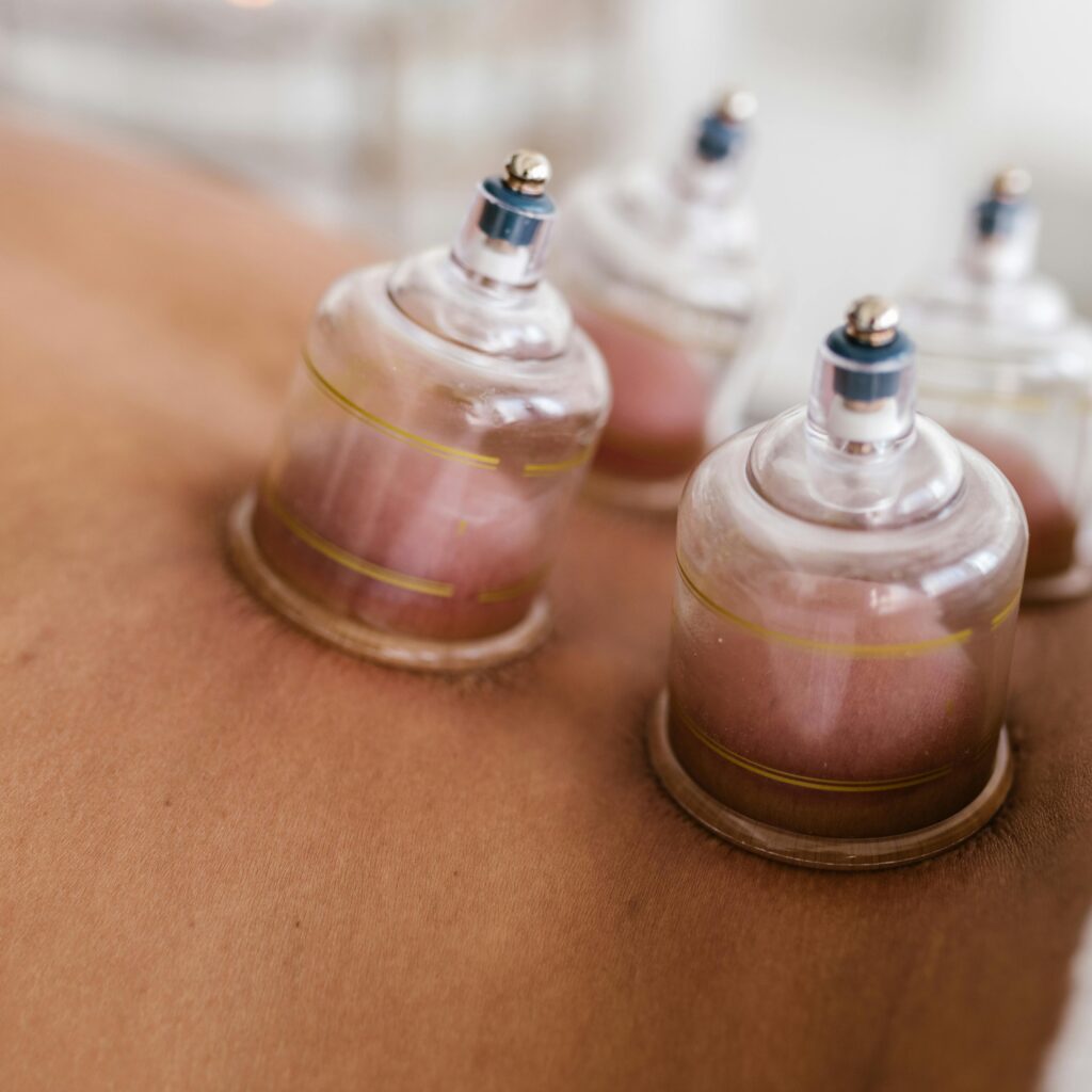 Detailed image of cupping therapy on a person's back, showcasing alternative medicine practice.